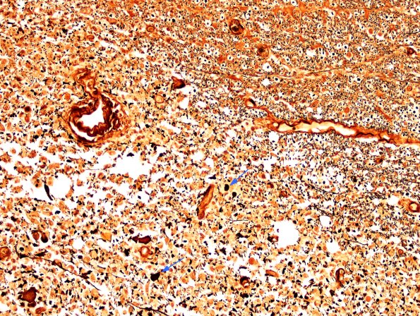 3B12 Neuromyelitis Optica (Case 3) Biels 20X, Block L copy