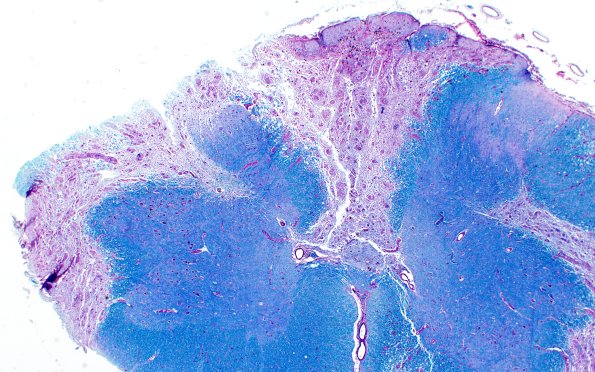 3B14 Neuromyelitis Optica (Case 3) LFB-PAS 2X 1A