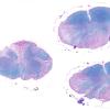 3B2 Neuromyelitis Optica (Case 3) LFB-PAS whole mount, Block L 1