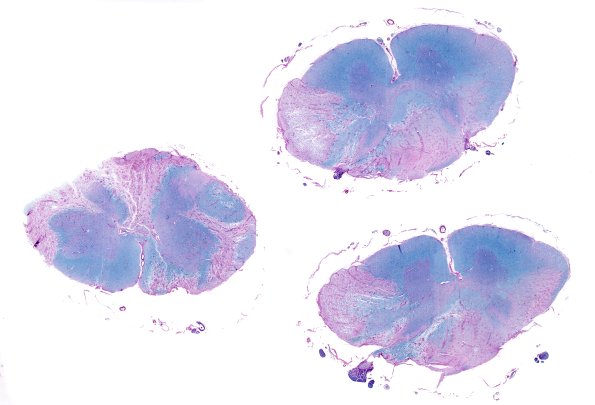 3B2 Neuromyelitis Optica (Case 3) LFB-PAS whole mount, Block L 1