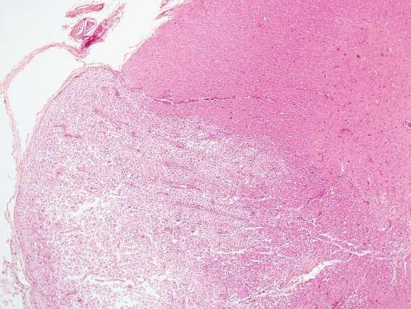 3B4 Neuromyelitis Optica (Case 3) H&E 4X, Block L