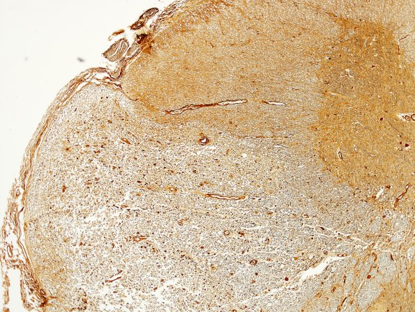 3B6 Neuromyelitis Optica (Case 3) Biels 4X, Block L