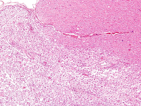 3B7 Neuromyelitis Optica (Case 3) H&E 10X Block L A