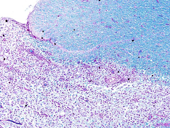 3B8 Neuromyelitis Optica (Case 3) LFB-PAS 10X, Block L