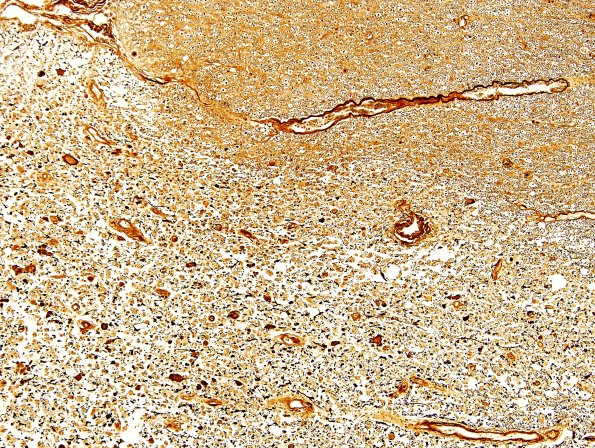 3B9 Neuromyelitis Optica (Case 3) Biels 10X, Block L