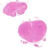 3C1 Neuromyelitis Optica (Case 3) H&E 4