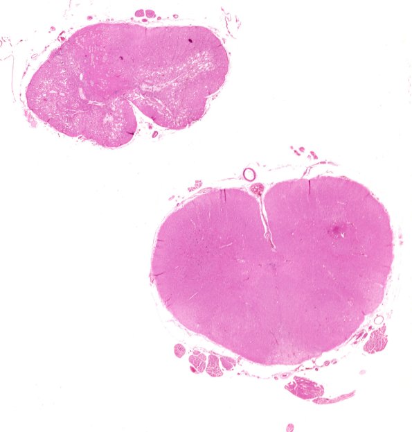 3C1 Neuromyelitis Optica (Case 3) H&E 4