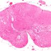 3C2 Neuromyelitis Optica (Case 3) H&E 2X 1B