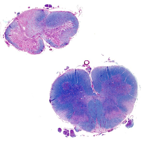 3C3 Neuromyelitis Optica (Case 3) LFB-PAS 5