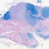 3C4 Neuromyelitis Optica (Case 3) LFB-PAS 2X 1P