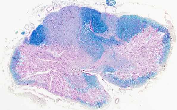 3C4 Neuromyelitis Optica (Case 3) LFB-PAS 2X 1P