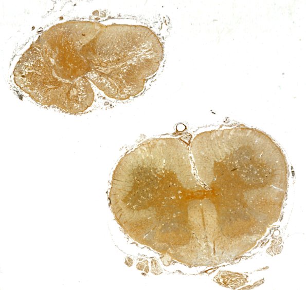 3C5 Neuromyelitis Optica (Case 3) Biels 2X 1C copy