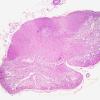 3D1 Neuromyelitis Optica (Case 3) H&E whole mount, Block M 1