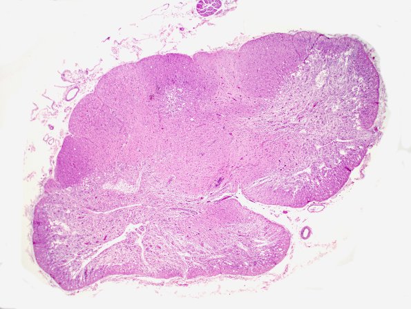 3D1 Neuromyelitis Optica (Case 3) H&E whole mount, Block M 1