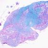 3D2 Neuromyelitis Optica (Case 3) LFB-PAS whole mount, Block M 1