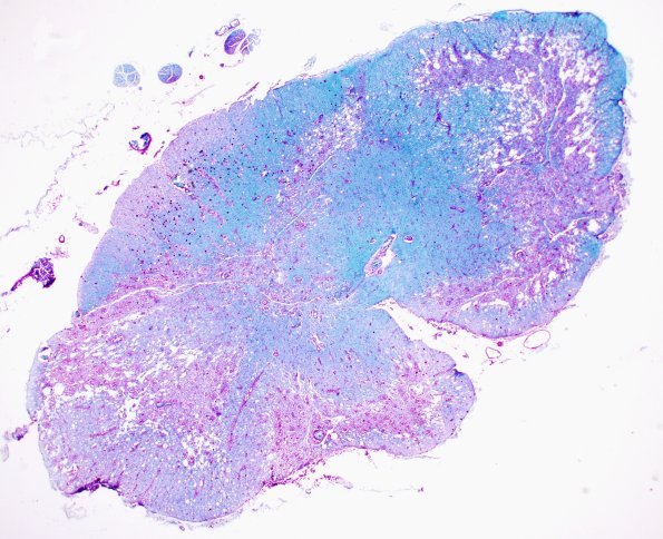 3D2 Neuromyelitis Optica (Case 3) LFB-PAS whole mount, Block M 1