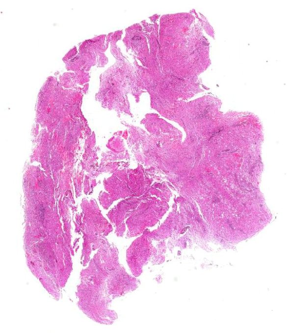 4A1 Neuromyelitis Optica (NMO, AANP DSS 2009 Case 6) Spinal Cord H&E 3