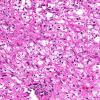 4A2 Neuromyelitis Optica (NMO, AANP DSS 2009 Case 6) Spinal Cord H&E 6