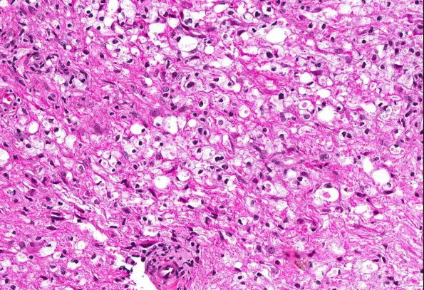 4A2 Neuromyelitis Optica (NMO, AANP DSS 2009 Case 6) Spinal Cord H&E 6