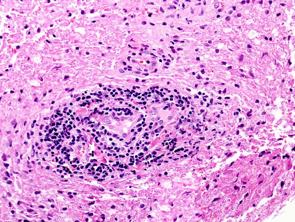 4A4 Neuromyelitis Optica (NMO, AANP DSS 2009 Case 6) Spinal Cord  H&E 5