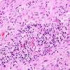 4A5 Neuromyelitis Optica (NMO, AANP DSS 2009 Case 6) Spinal Cord H&E 1