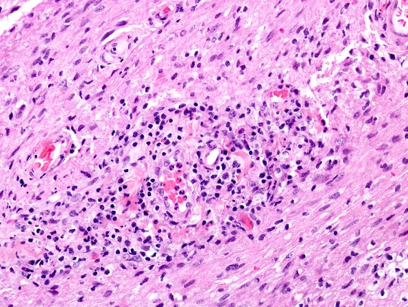 4A5 Neuromyelitis Optica (NMO, AANP DSS 2009 Case 6) Spinal Cord H&E 1