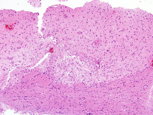 1A1 MS, Sentinel (Case 1- Bx) 10X