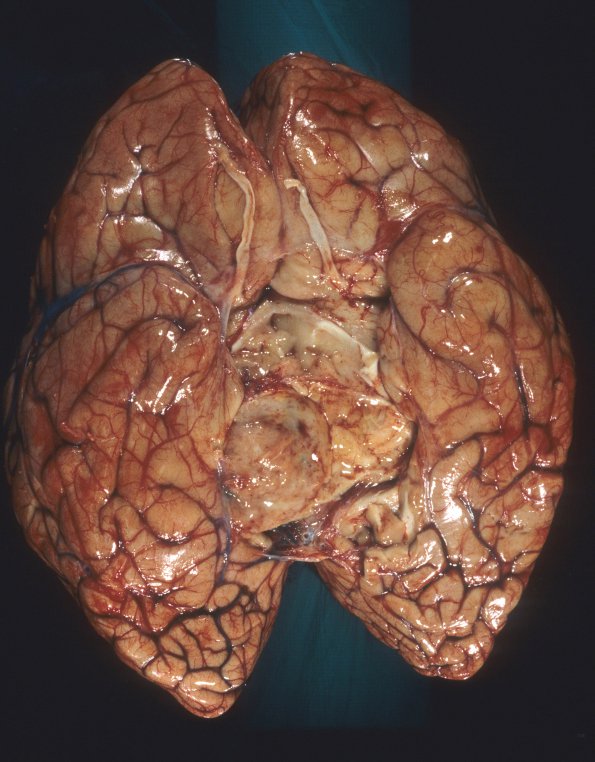 1B1 Lymphoma, sentinel lesion MS to neoplasm in 4 months (Case 1 - Autopsy) 5