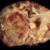 1B2 Lymphoma, sentinel lesion MS to neoplasm in 4 months (Case 1 - Autopsy) 1