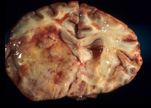 1B2 Lymphoma, sentinel lesion MS to neoplasm in 4 months (Case 1 - Autopsy) 1