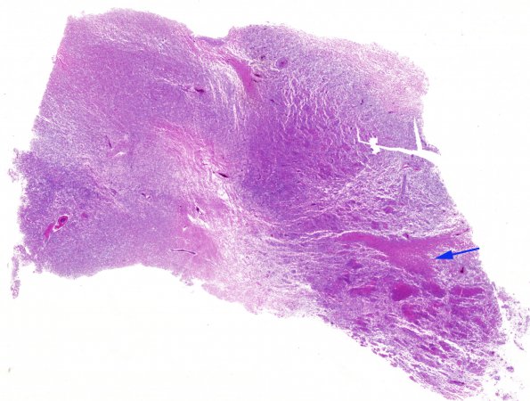 1C1 Lymphoma, sentinel lesion MS to neoplasm in 4 months (Case 1 - Autopsy) 1 copy