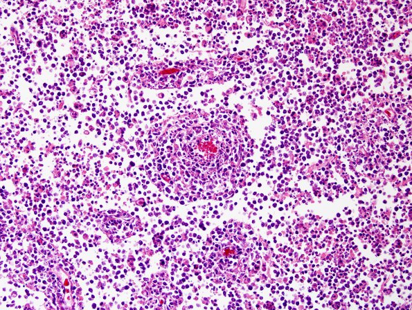 1C2 Sentinel Lesion (Case 1 - Autopsy) N12 H&E 3