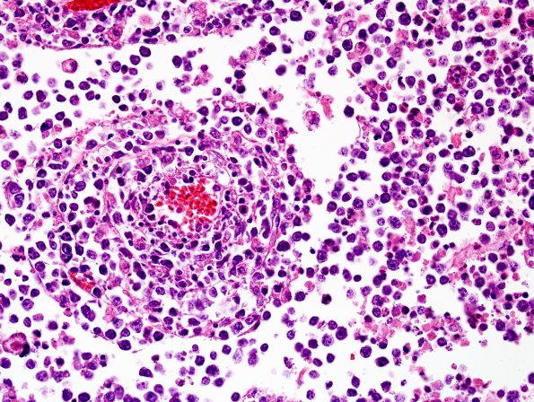 1C3 Sentinel Lesion (Case 1 - Autopsy) N12 H&E 2