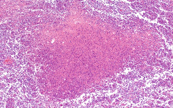 1C5 Sentinel Lesion (Case 1 - Autopsy) N12 H&E A3 necrosis