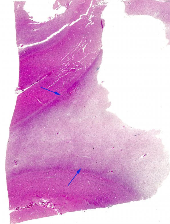 1D1 Sentinel Lesion (Case 1 - Autopsy) N17 H&E whole mount copy