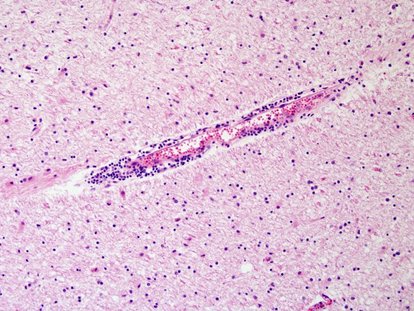 1D2 Sentinel Lesion (Case 1 - Autopsy) N17 H&E 2