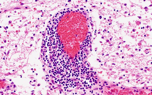 1G4 Sentinel Lesion (Case 1 - Autopsy) N15 40X demyelination not tumor 2