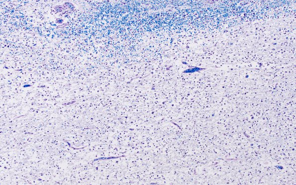 1H2 Sentinel Lesion (Case 1 - Autopsy) N15 LFB-PAS 4X 2