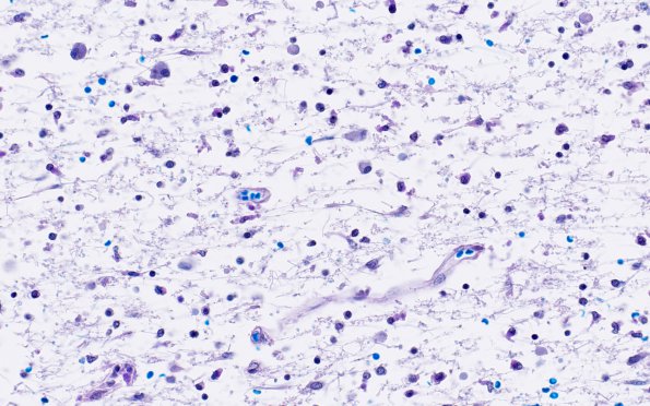 1H3 Sentinel Lesion (Case 1 - Autopsy) N15 LFB-PAS 40X