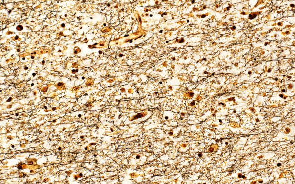 1J2 Sentinel Lesion (Case 1 - Autopsy) N15 Bielschowsky 40X