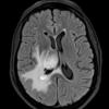 2A1 Sentinel lesion FLAIR (Case 2 - 1st Bx) - Copy - Copy