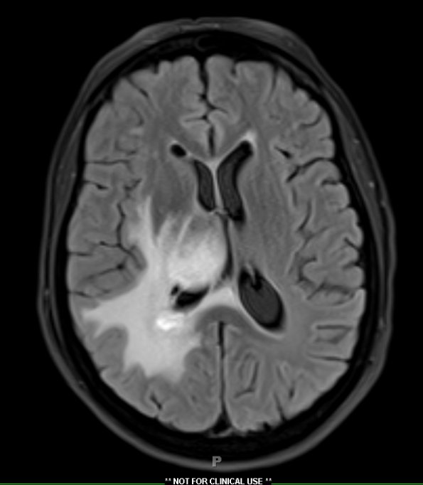 2A1 Sentinel lesion FLAIR (Case 2 - 1st Bx) - Copy - Copy