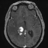 2A2 Sentinel lesion (Case 2 - 1st Bx) T1 with contrast 2 - Copy - Copy