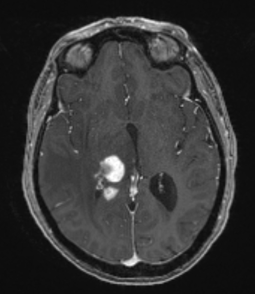 2A2 Sentinel lesion (Case 2 - 1st Bx) T1 with contrast 2 - Copy - Copy