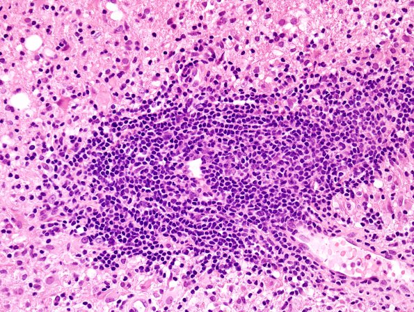 2B2 Sentinel Lesion (Case 2 - 1st Bx) area A H&E 8