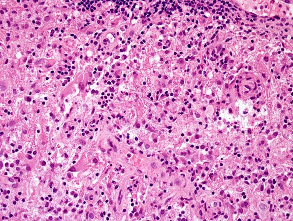 3B5 Sentinel Lesion (Case 2 - 1st Bx) area A H&E 1 1