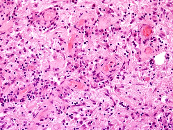 2B6 Sentinel Lesion (Case 2 - 1st Bx) area A H&E 5