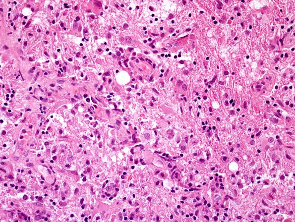 2B7 Sentinel Lesion (Case 2 - 1st Bx) area B H&E 3