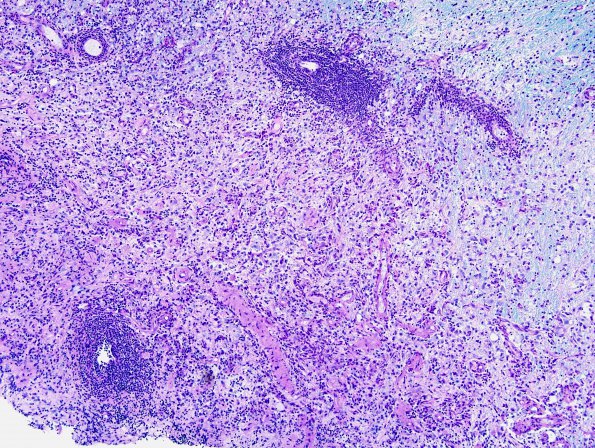 2C1 Sentinel Lesion (Case 2 - 1st Bx) area A LFB-PAS 10X