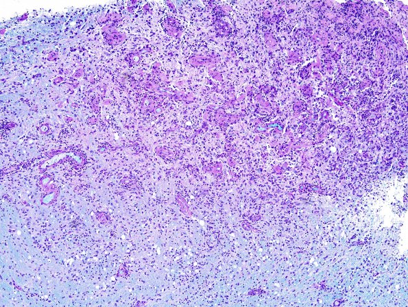 2C2 Sentinel Lesion (Case 2 - 1st Bx) area B LFB-PAS 10X